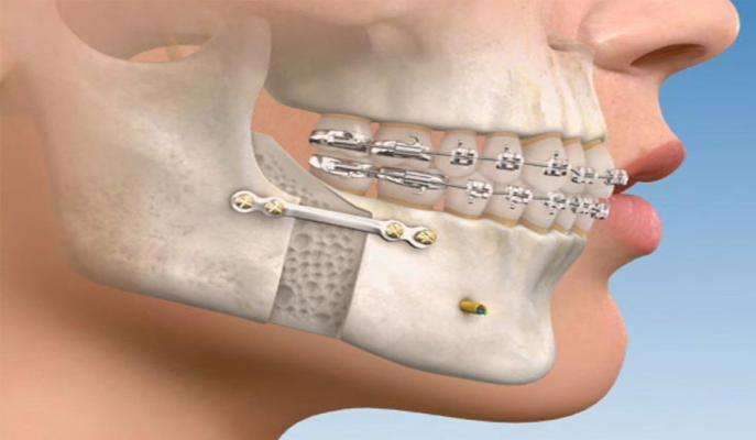 Cirurgia Buco-Maxilo-Facial